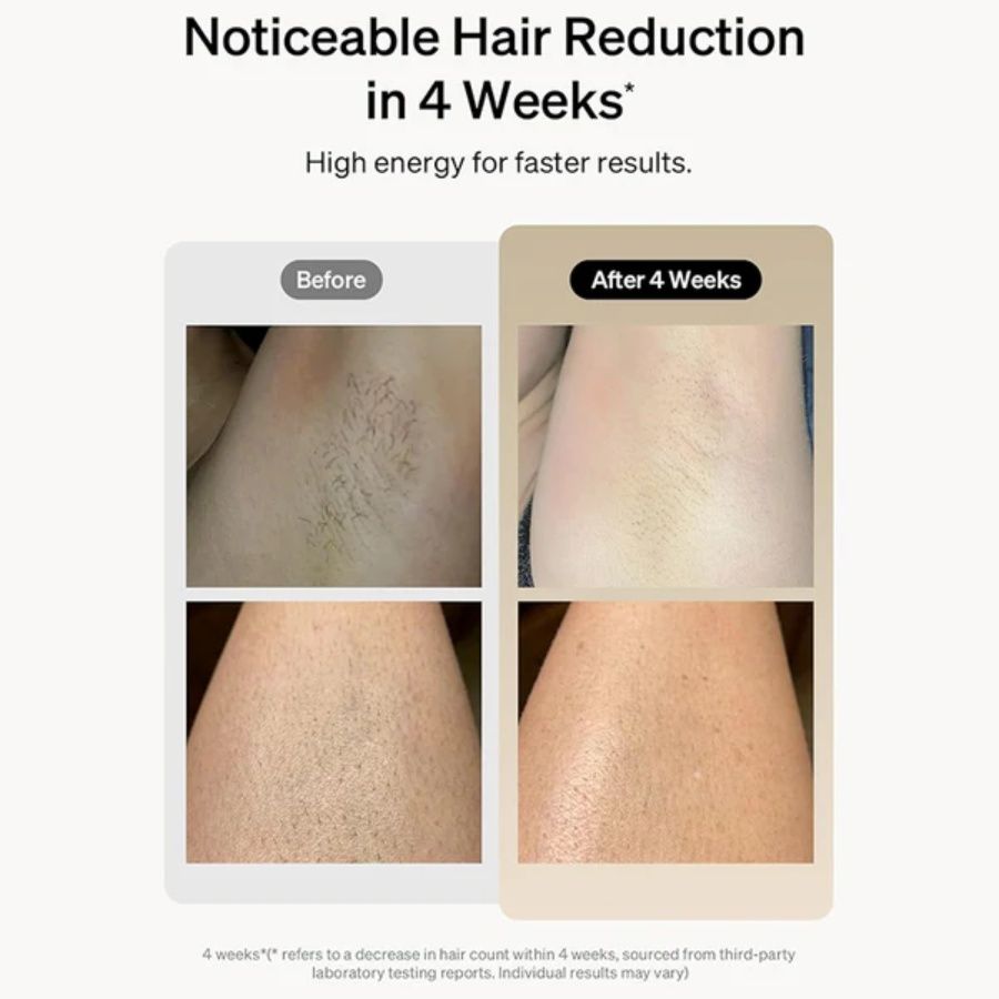 Laser Hair Removal 900,000 Flashes 5 Gears IPL Laser Epilator Hair